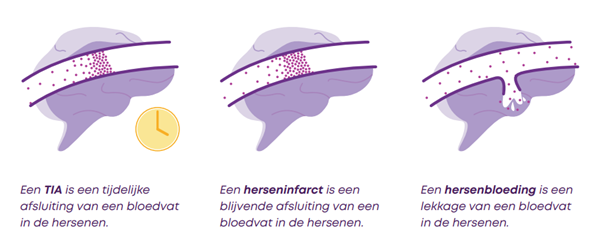 Het verschil tussen een TIA, herseninfarct en een hersenbloeding.